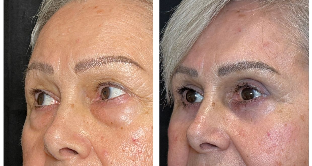 Antes y después - blefaroplastia España