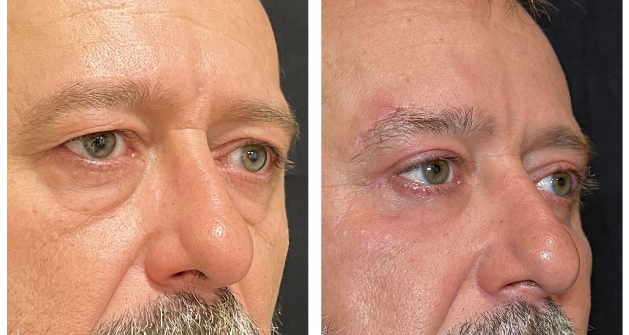 Antes y después - blefaroplastia España