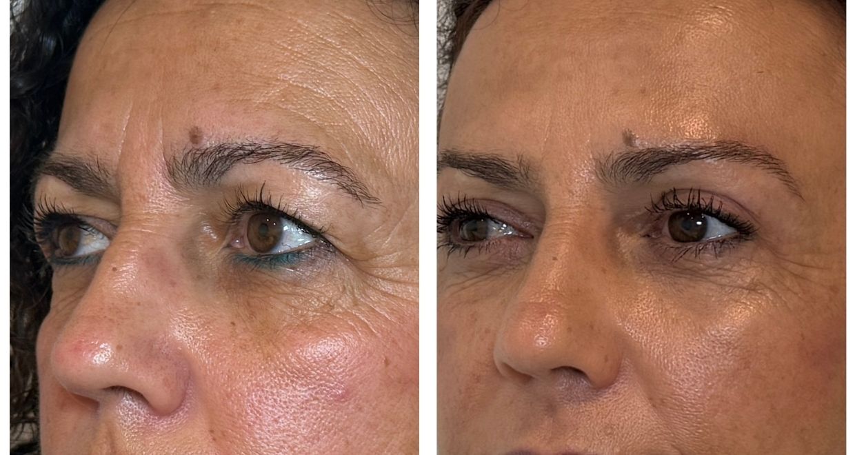 Antes y después blefaroplastia España