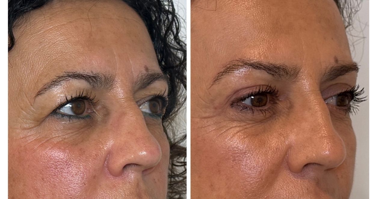 Antes y después blefaroplastia