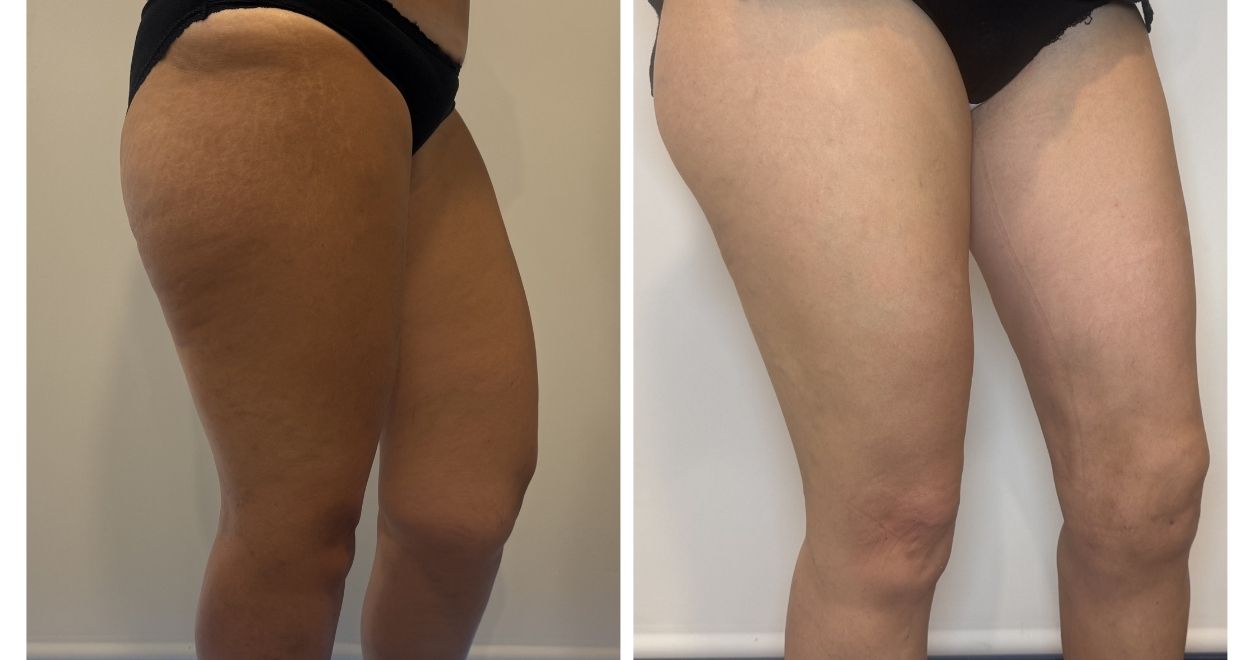 Antes y después lipedema España