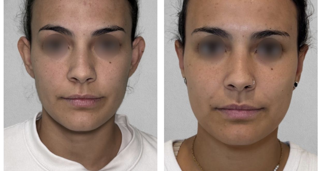 Resultados Otoplastia