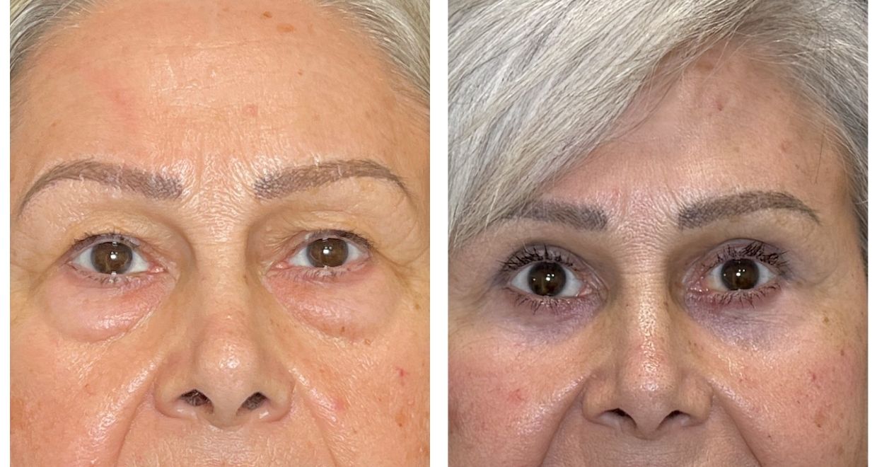 Resultados - blefaroplastia