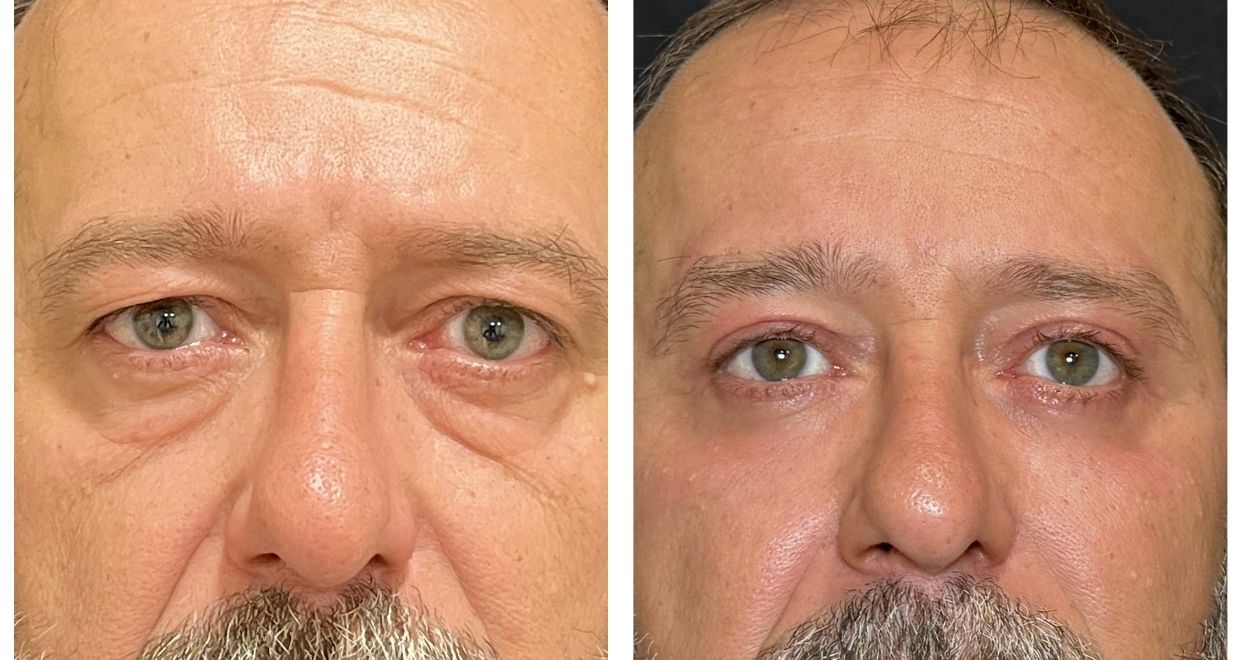 Resultados - blefaroplastia
