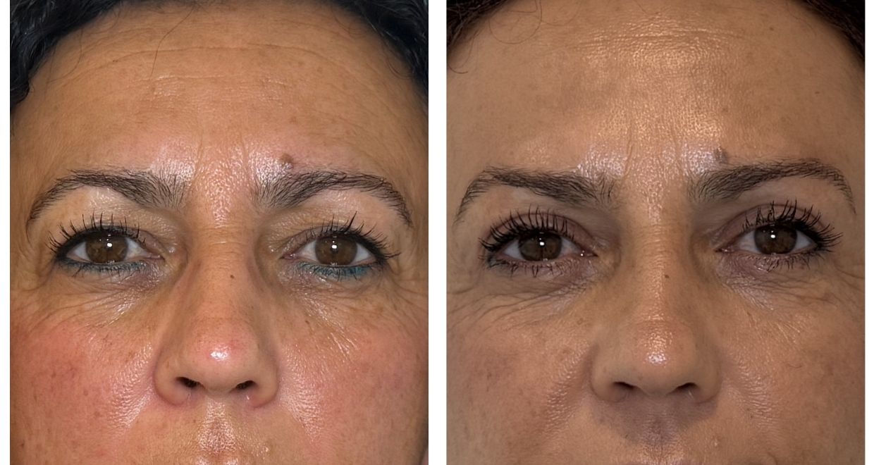 Resultados blefaroplastia