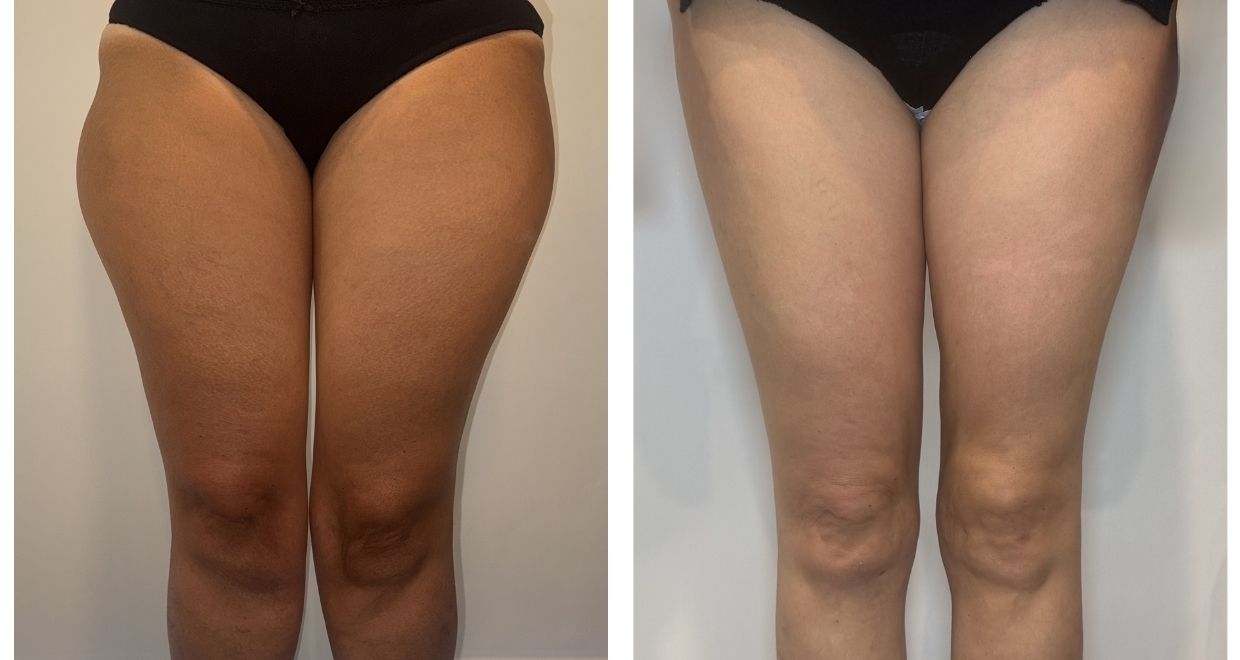 Resultados reales de lipedema antes y después
