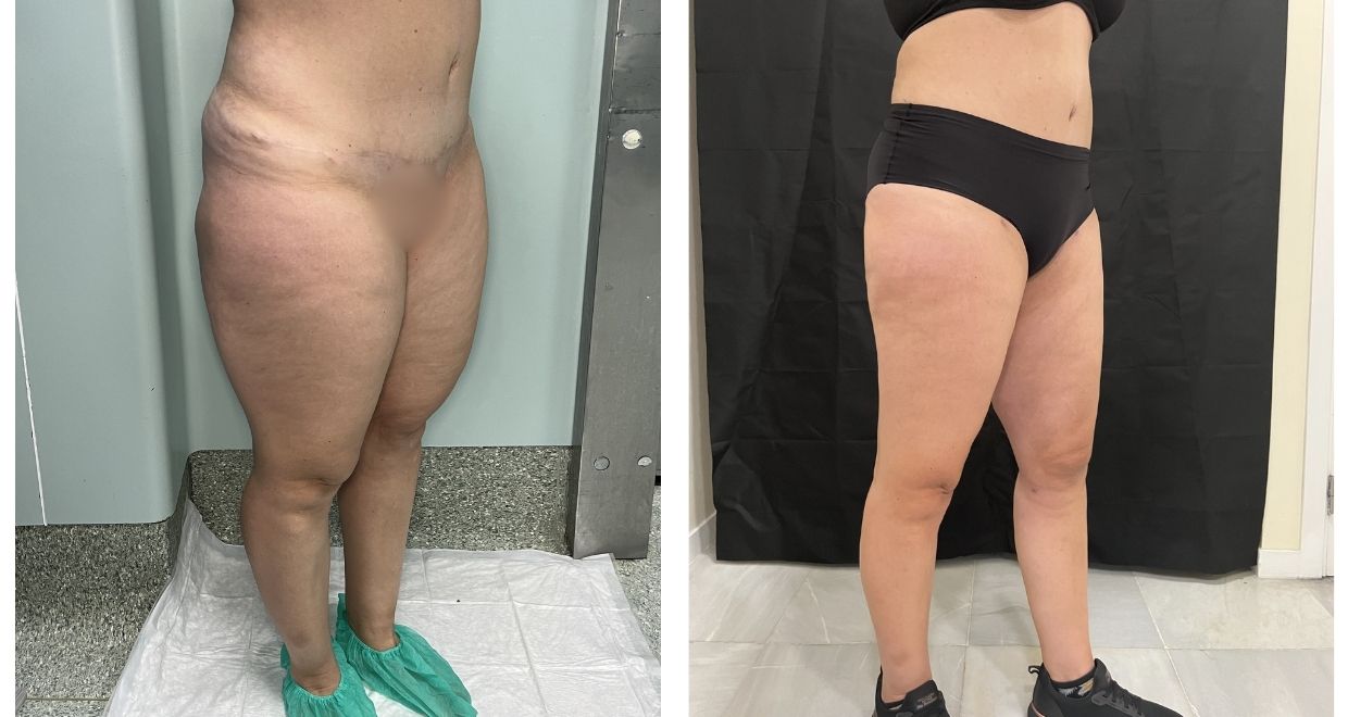 Resultados reales de lipedema