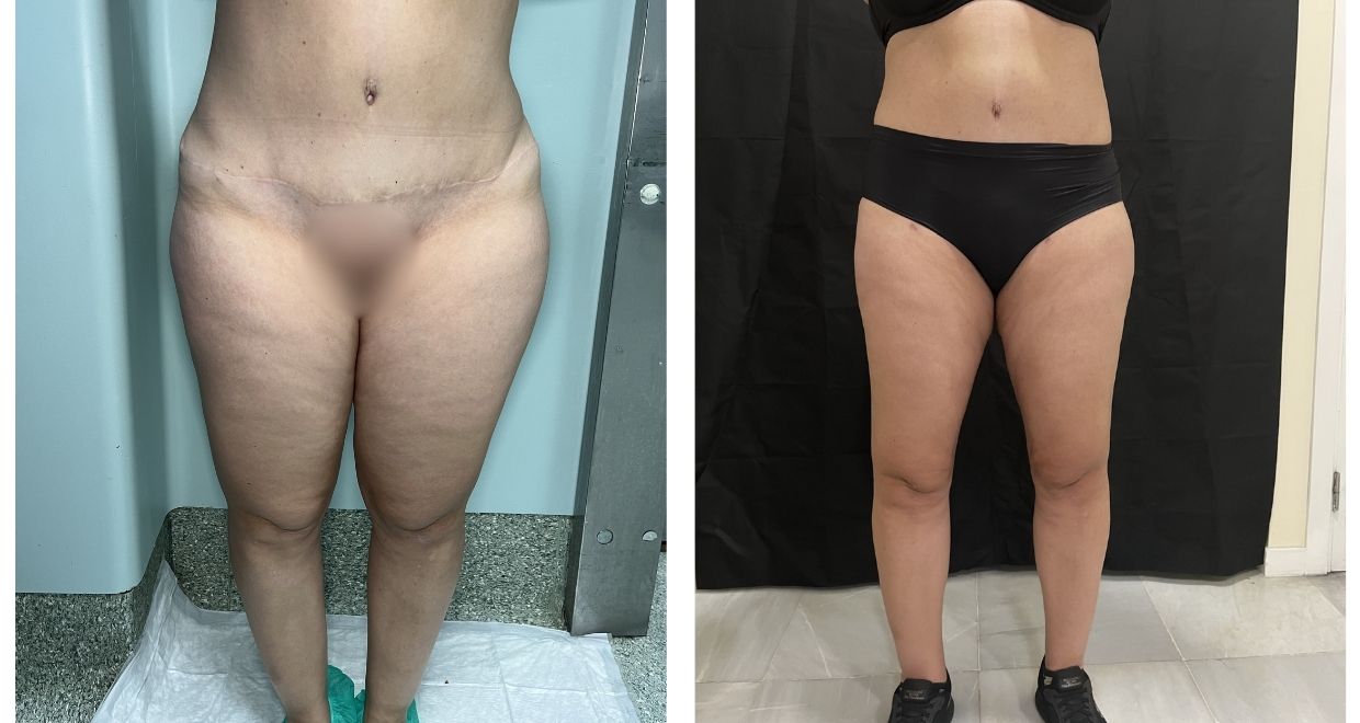 Resultados reales lipedema