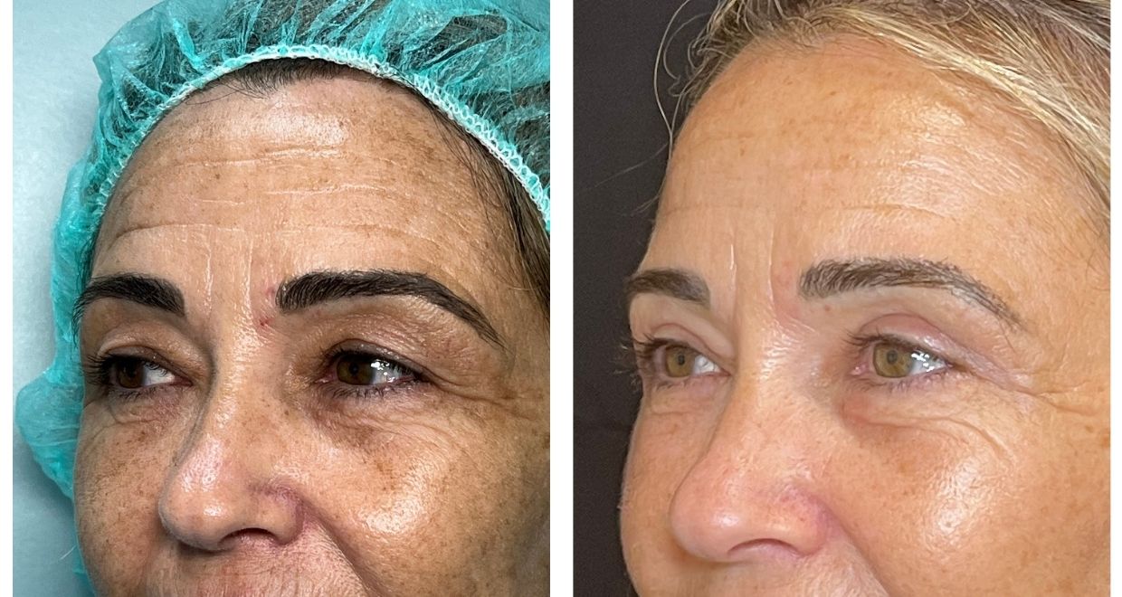 blefaroplastia Antes y después España