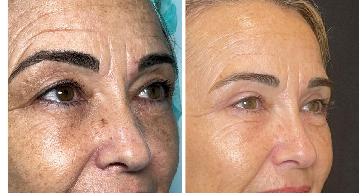 blefaroplastia Antes y después