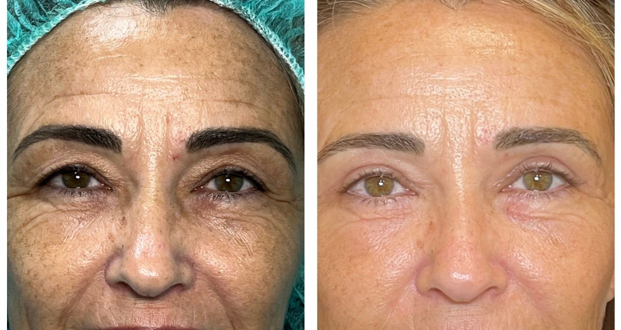 blefaroplastia resultados