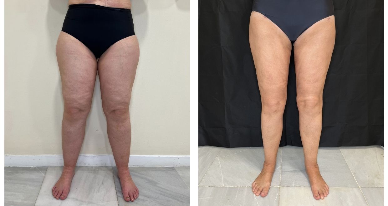 lipedema en miembros inferiores reducción
