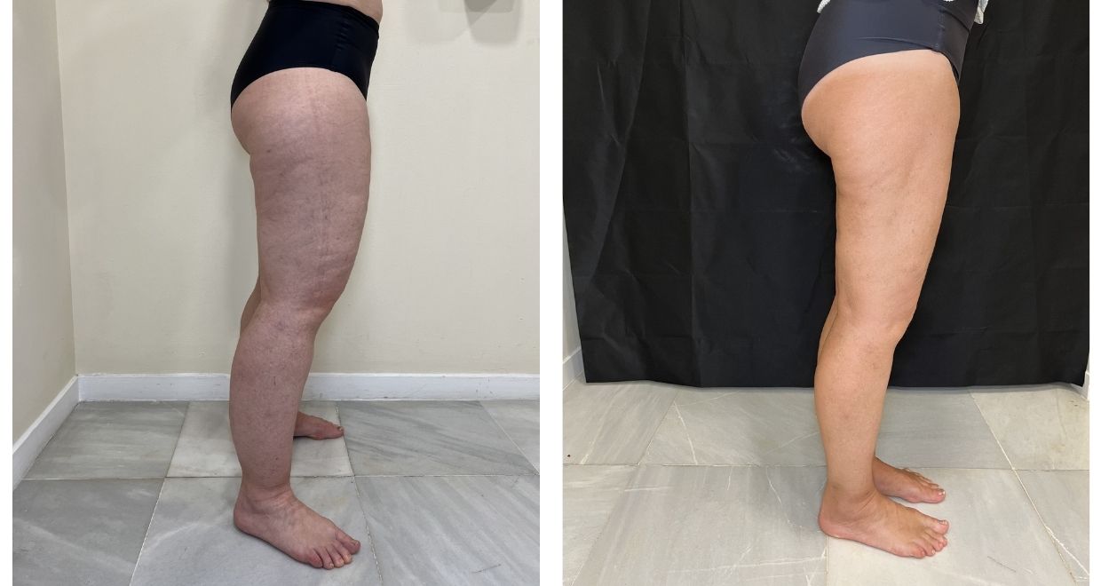 lipedema en miembros inferiores