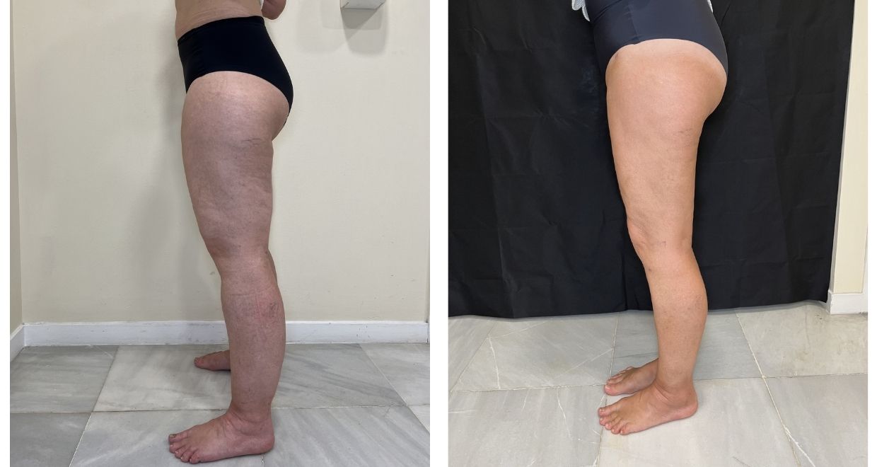 lipedema en piernas